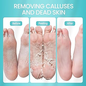 Exfoliating Foot Peel Mask - Removes Dead Skin & Calluses